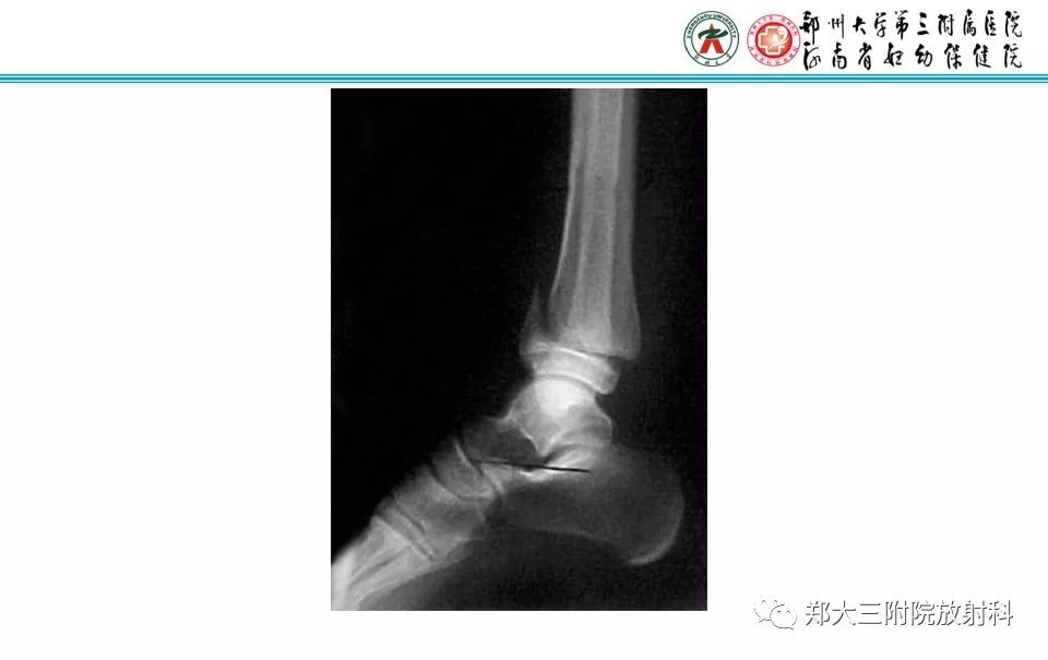 【PPT】骨骺损伤的影像诊断