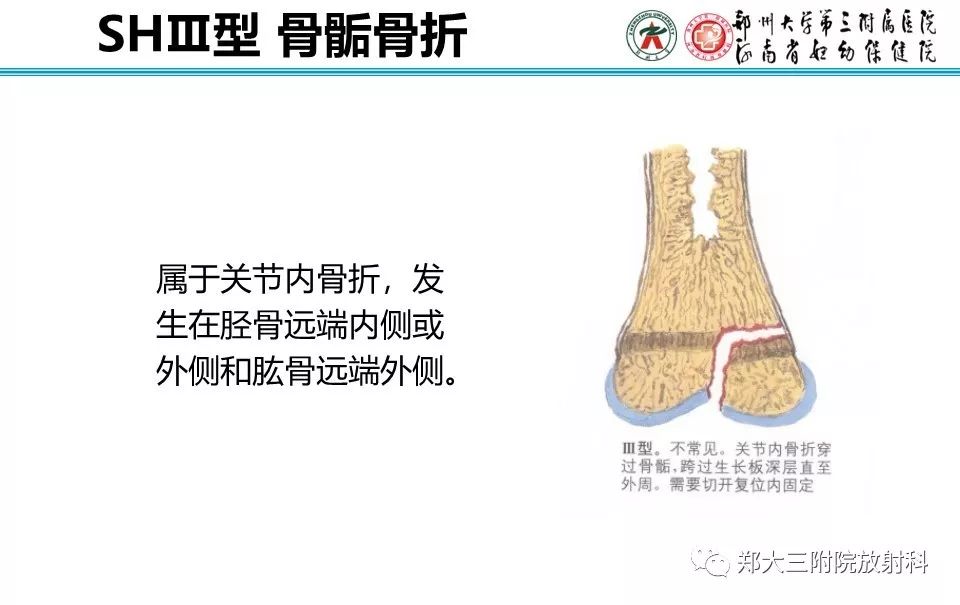 【PPT】骨骺损伤的影像诊断