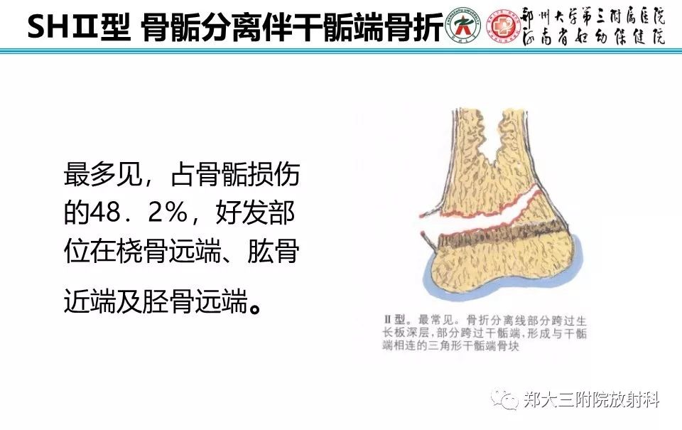 【PPT】骨骺损伤的影像诊断