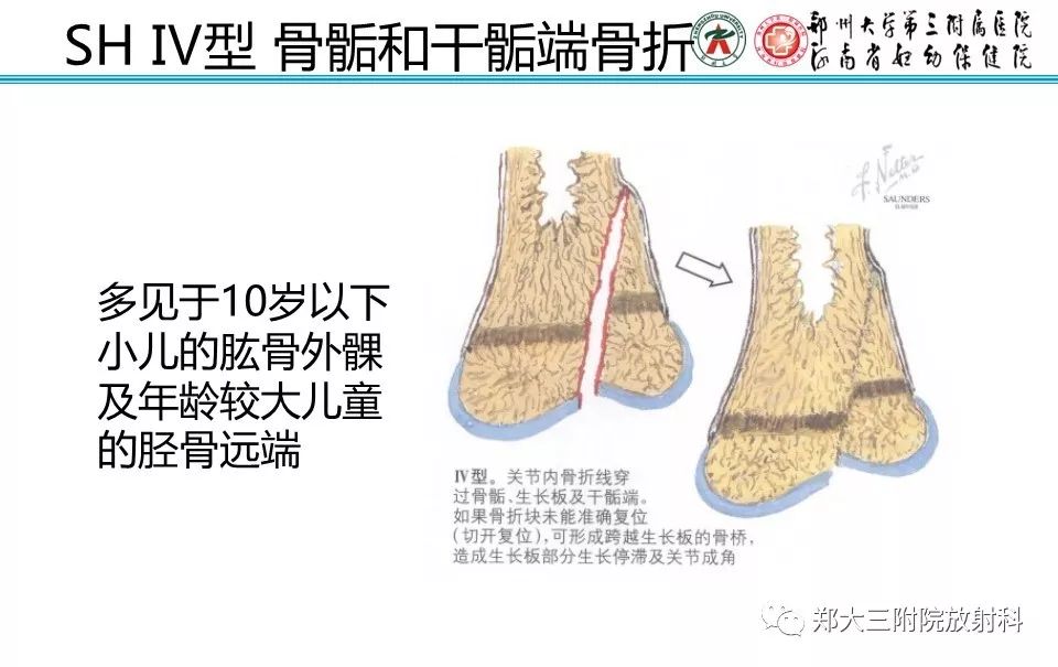 【PPT】骨骺损伤的影像诊断