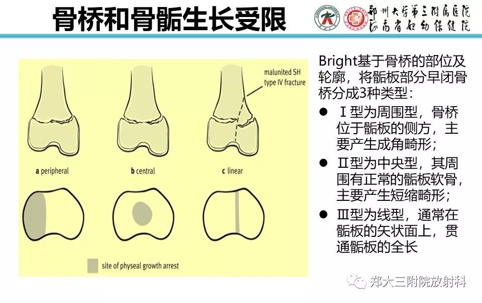 【PPT】骨骺损伤的影像诊断