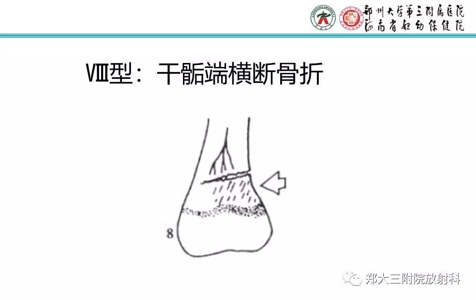 【PPT】骨骺损伤的影像诊断