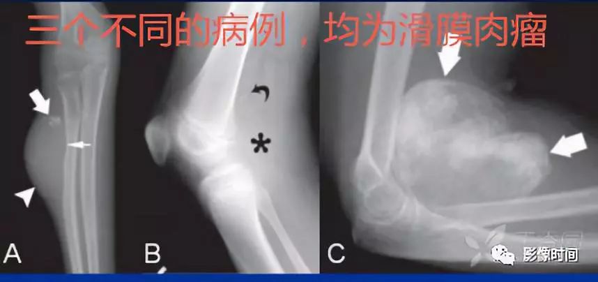 七大恶性骨肿瘤，背背诗就能了解啦！