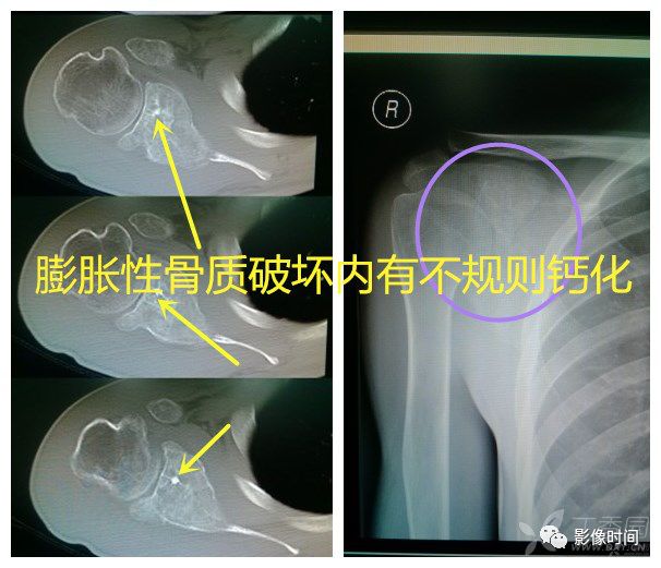 七大恶性骨肿瘤，背背诗就能了解啦！