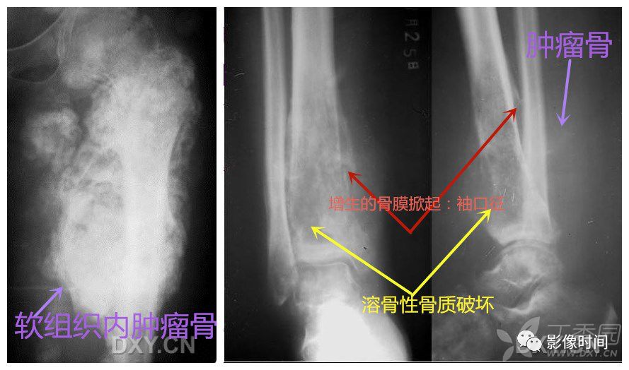 七大恶性骨肿瘤，背背诗就能了解啦！