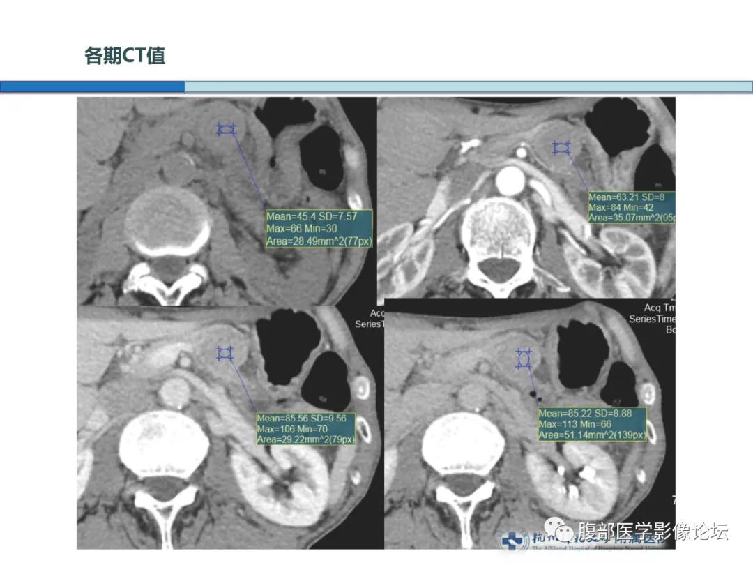 【病例】胰腺神经内分泌癌1例CT影像