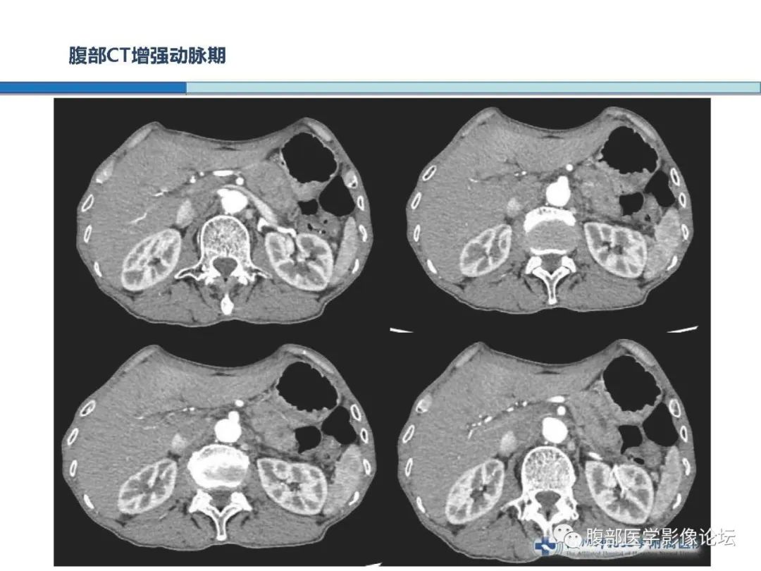 【病例】胰腺神经内分泌癌1例CT影像