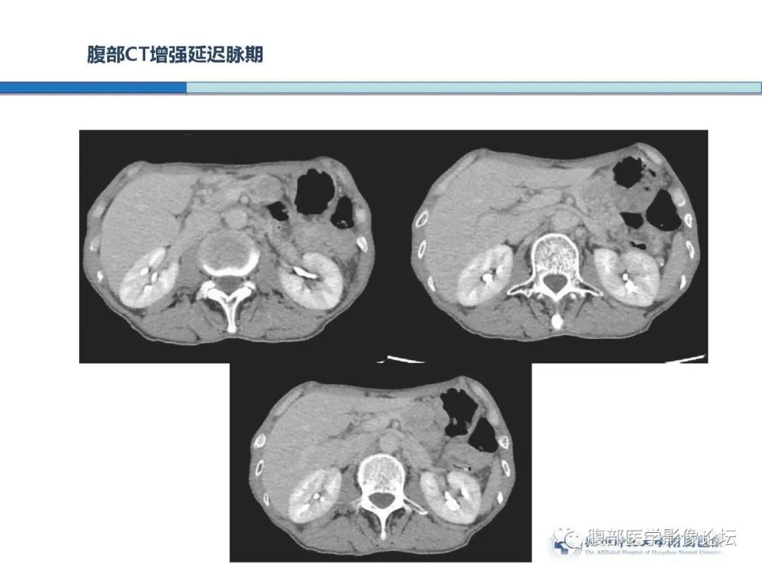 【病例】胰腺神经内分泌癌1例CT影像