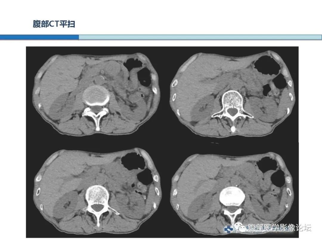 【病例】胰腺神经内分泌癌1例CT影像