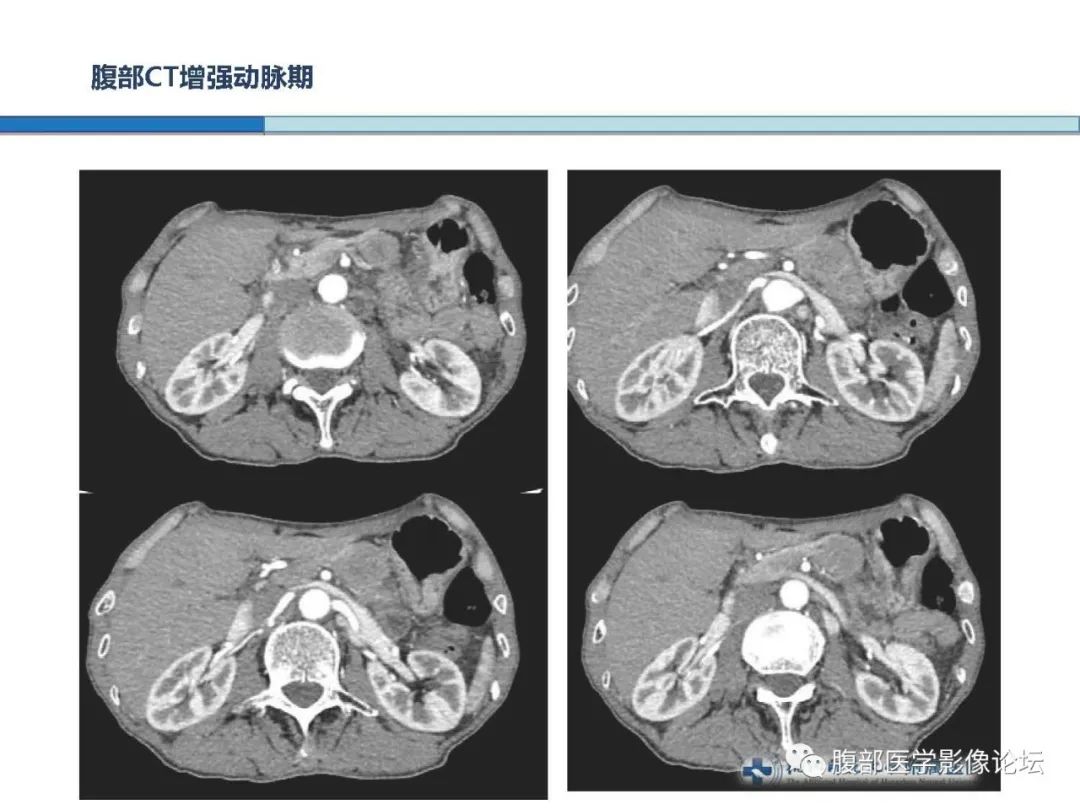 【病例】胰腺神经内分泌癌1例CT影像