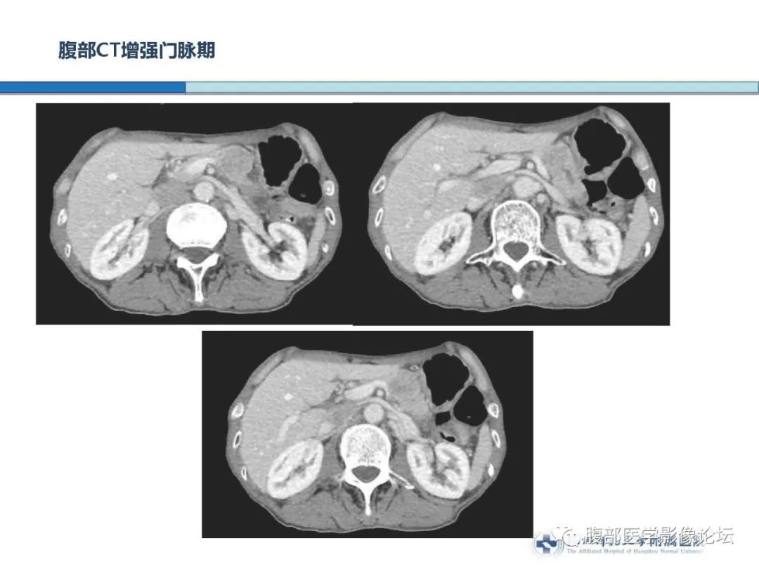 【病例】胰腺神经内分泌癌1例CT影像