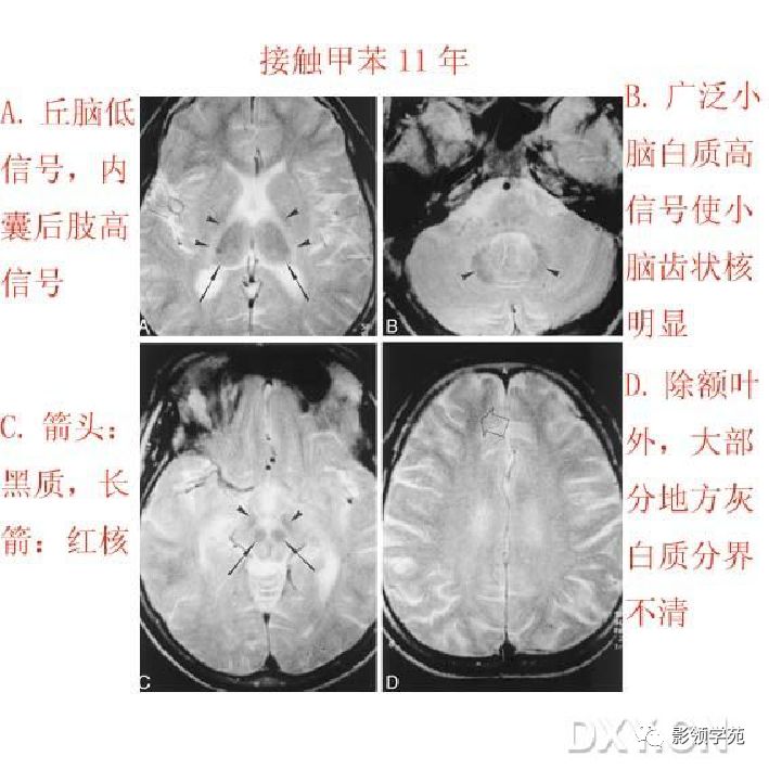 脑白质病变影像诊断 脑白质病变影像诊断