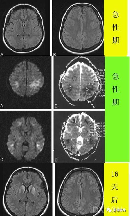 脑白质病变影像诊断 脑白质病变影像诊断