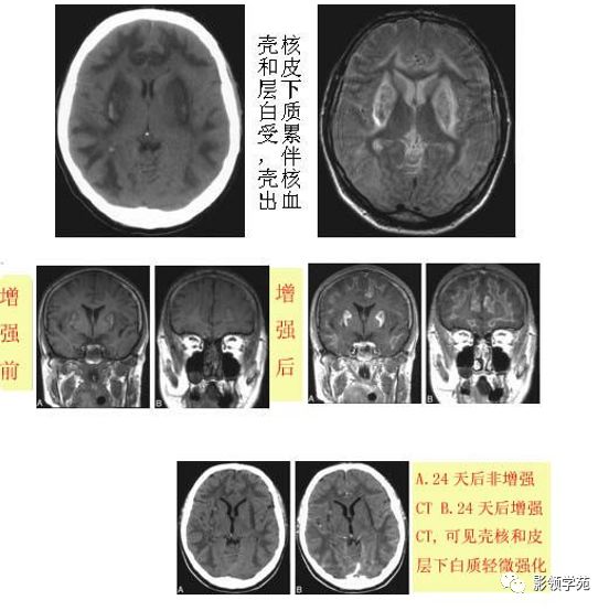 脑白质病变影像诊断 脑白质病变影像诊断