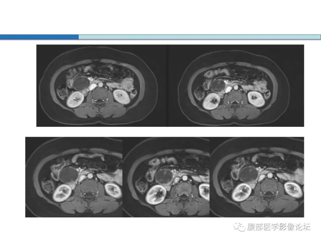 【病例】胰腺实性假乳头状肿瘤1例CT及MR
