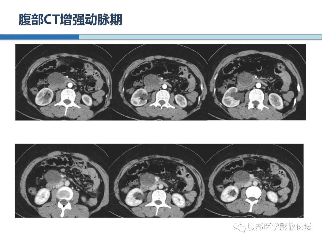 【病例】胰腺实性假乳头状肿瘤1例CT及MR
