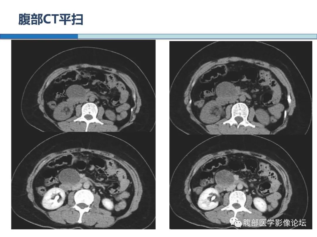 【病例】胰腺实性假乳头状肿瘤1例CT及MR
