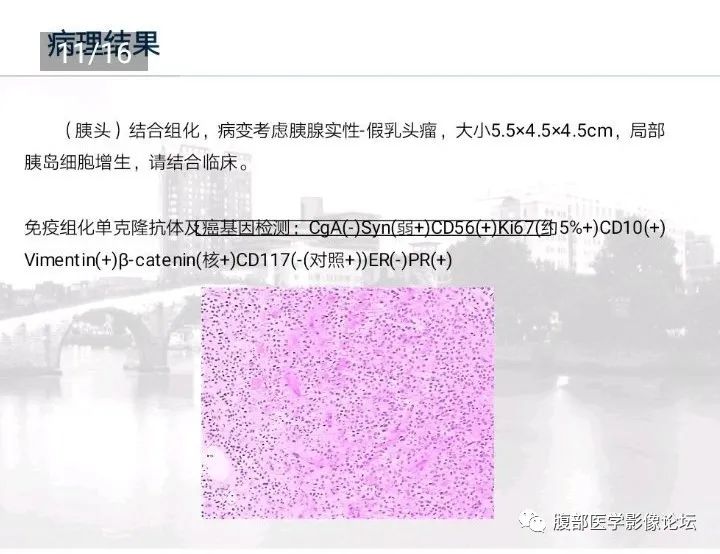 【病例】胰腺实性假乳头状肿瘤1例CT及MR