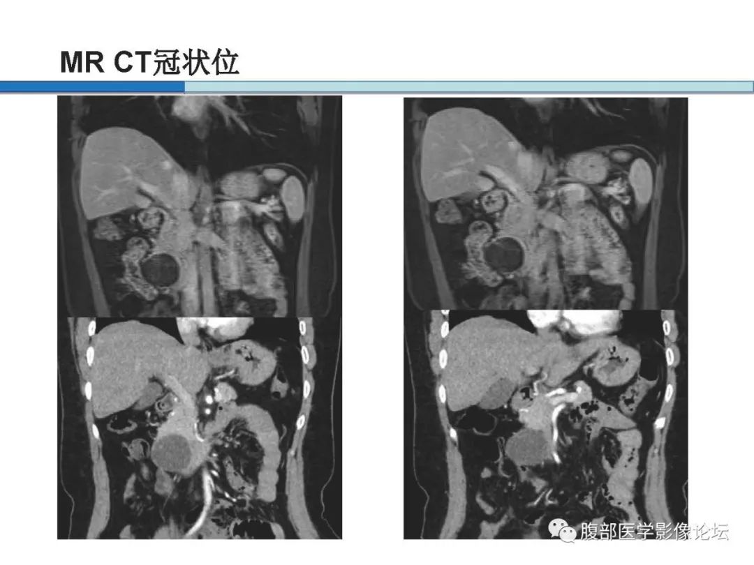 【病例】胰腺实性假乳头状肿瘤1例CT及MR