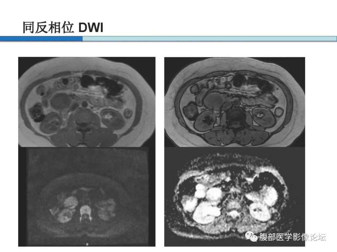 【病例】胰腺实性假乳头状肿瘤1例CT及MR