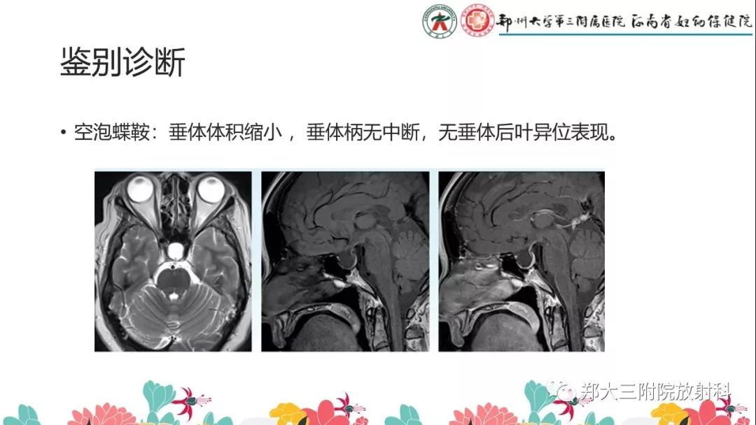【PPT】先天性垂体发育不良