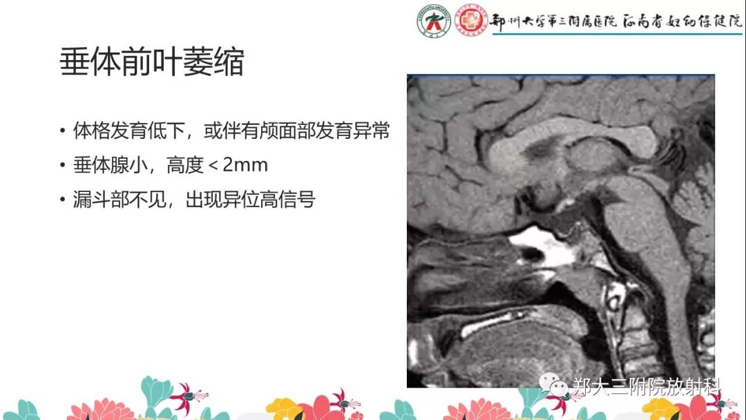 【PPT】先天性垂体发育不良