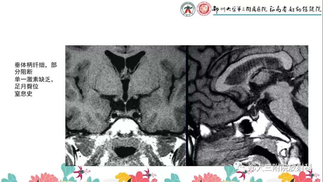 【PPT】先天性垂体发育不良