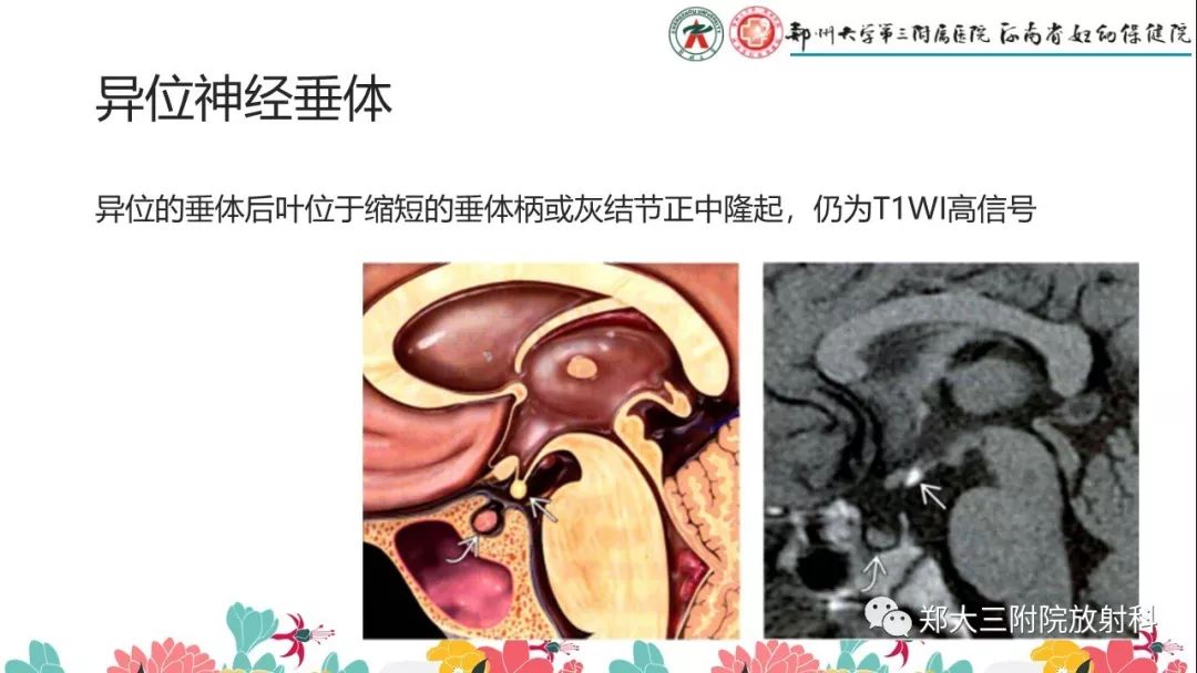 【PPT】先天性垂体发育不良