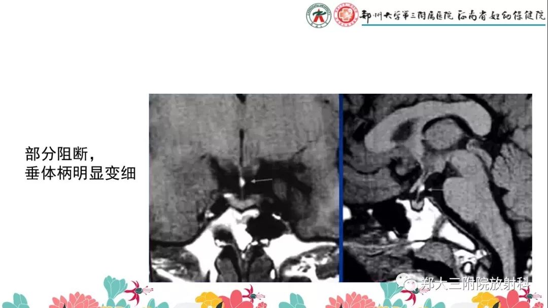 【PPT】先天性垂体发育不良