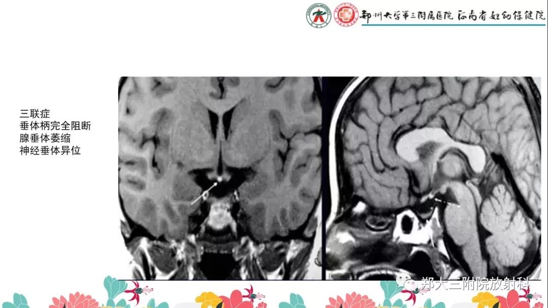 【PPT】先天性垂体发育不良