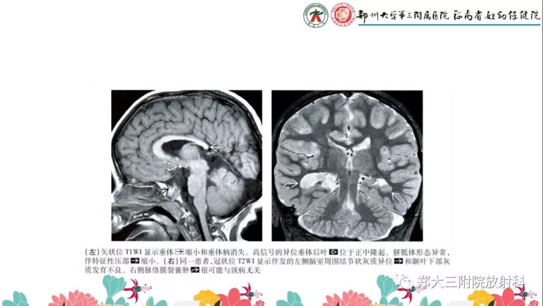 【PPT】先天性垂体发育不良