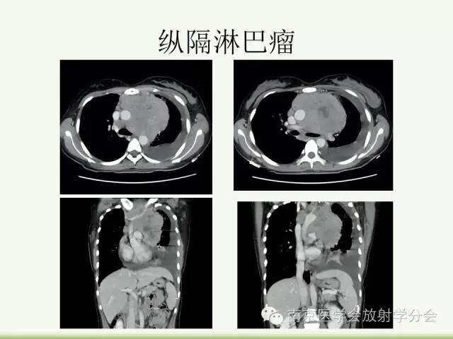 【病例】纵隔结核1例CT影像表现