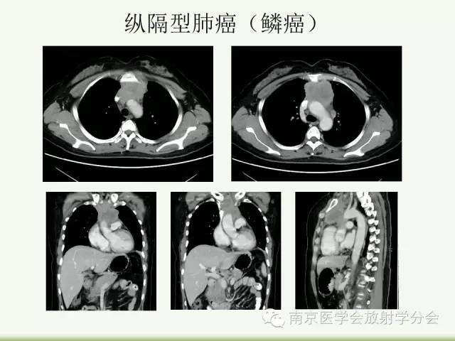 【病例】纵隔结核1例CT影像表现