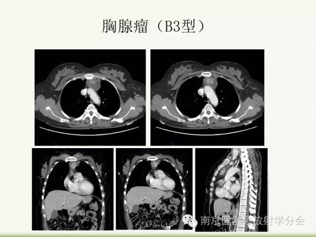【病例】纵隔结核1例CT影像表现