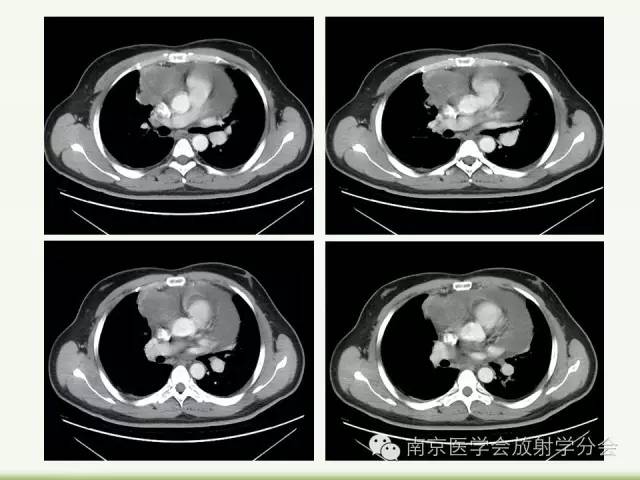 【病例】纵隔结核1例CT影像表现