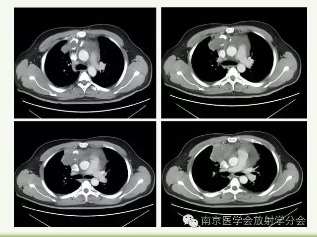 【病例】纵隔结核1例CT影像表现