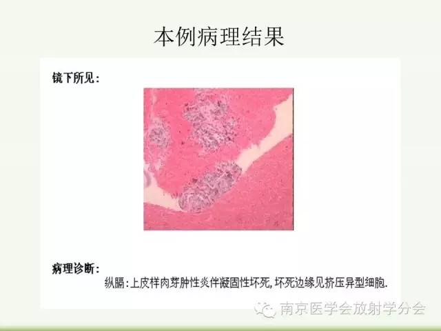 【病例】纵隔结核1例CT影像表现