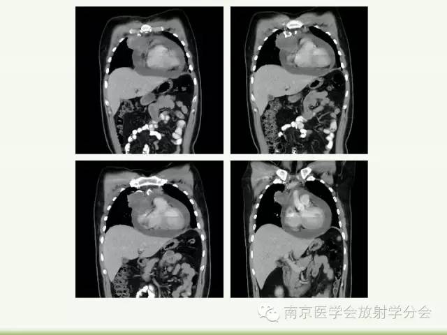 【病例】纵隔结核1例CT影像表现