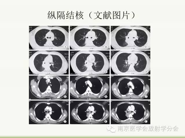 【病例】纵隔结核1例CT影像表现