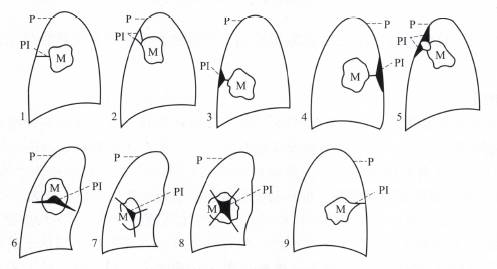 “胸膜凹陷征” 的影像表现与临床意义
