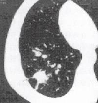 “胸膜凹陷征” 的影像表现与临床意义