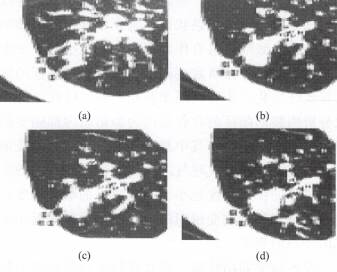 “胸膜凹陷征” 的影像表现与临床意义