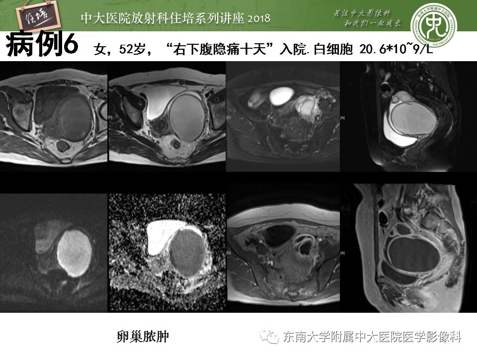 【PPT】卵巢占位诊断与鉴别