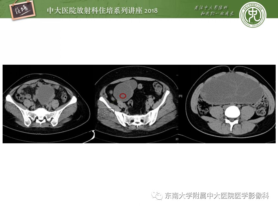 【PPT】卵巢占位诊断与鉴别