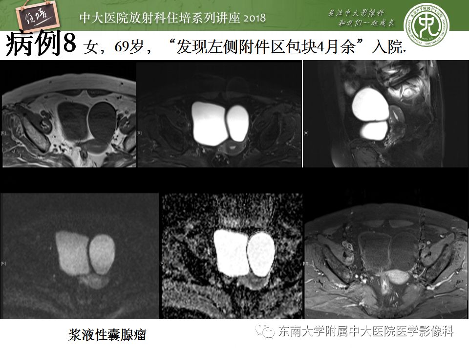 【PPT】卵巢占位诊断与鉴别
