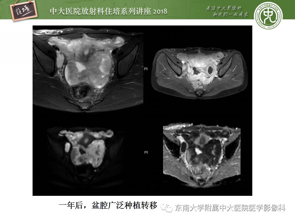 【PPT】卵巢占位诊断与鉴别