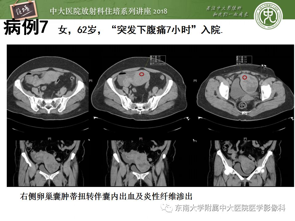 【PPT】卵巢占位诊断与鉴别