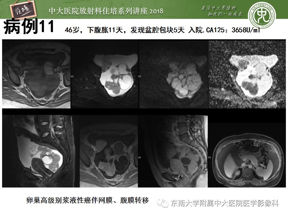 【PPT】卵巢占位诊断与鉴别