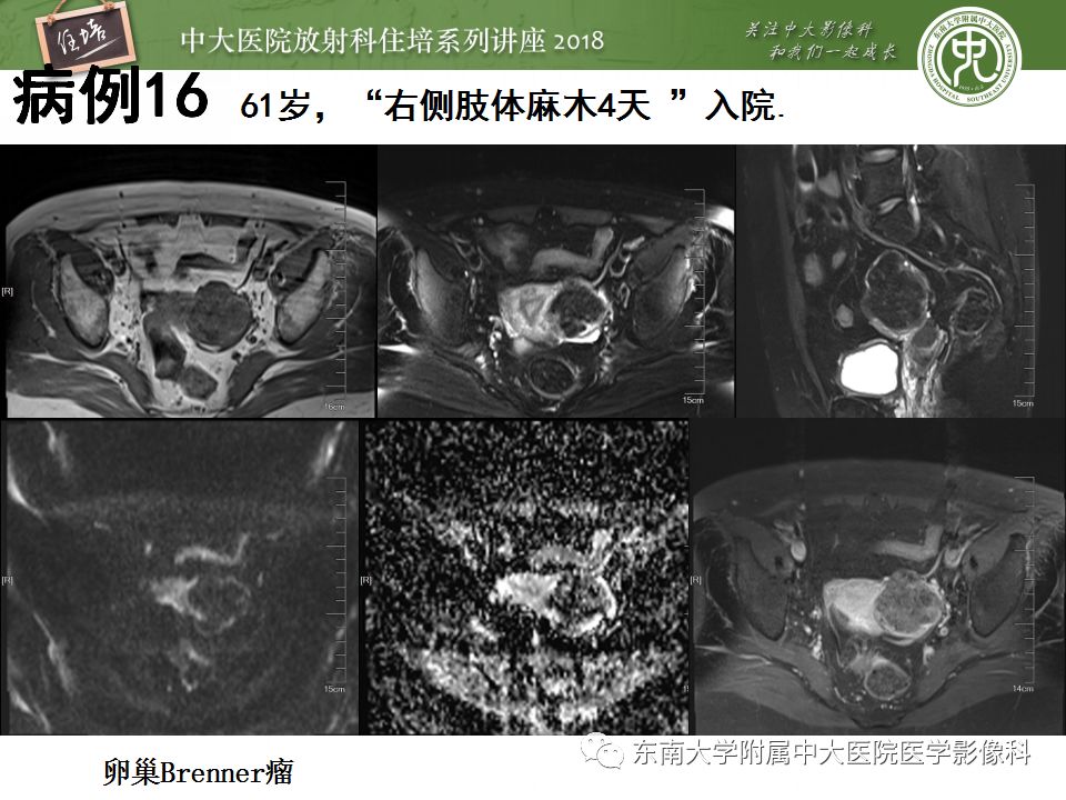 【PPT】卵巢占位诊断与鉴别