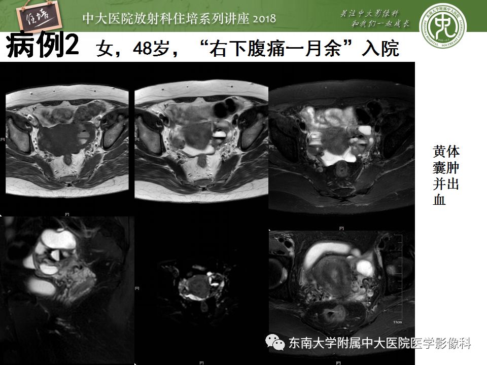 【PPT】卵巢占位诊断与鉴别
